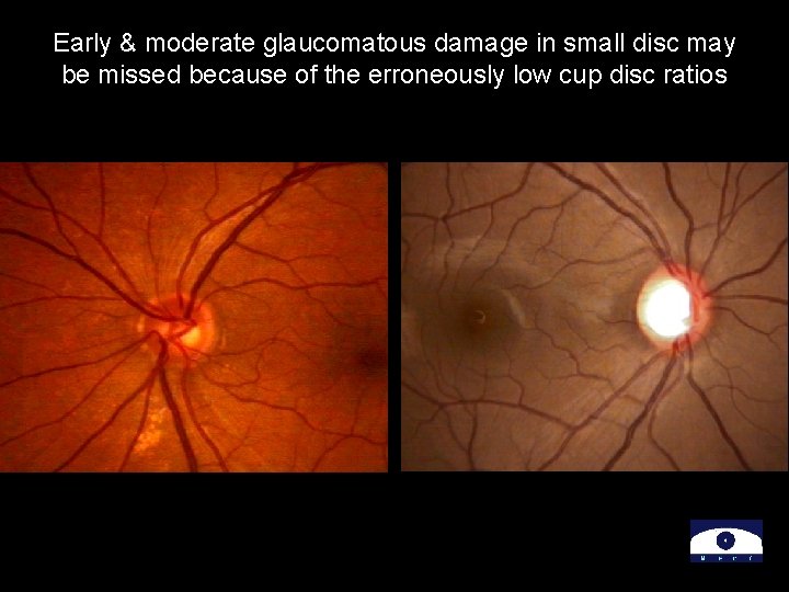 Early & moderate glaucomatous damage in small disc may be missed because of the