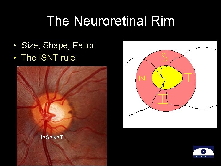 The Neuroretinal Rim • Size, Shape, Pallor. • The ISNT rule: I>S>N>T 