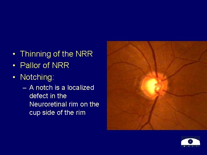  • Thinning of the NRR • Pallor of NRR • Notching: – A
