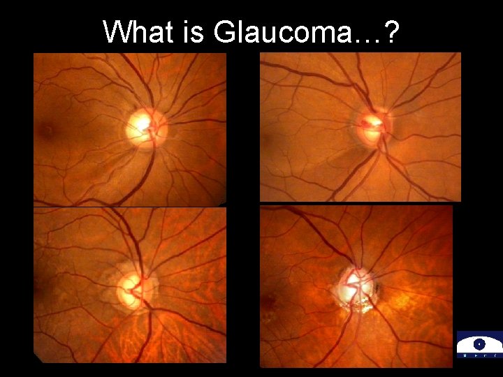 What is Glaucoma…? 