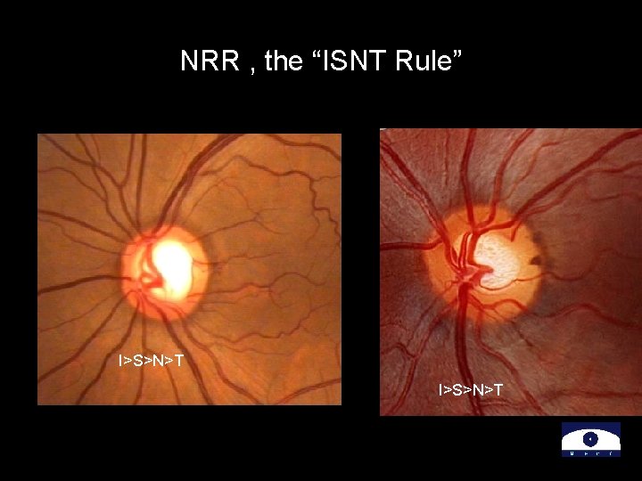 NRR , the “ISNT Rule” I>S>N>T 
