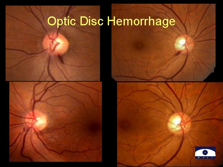 Optic Disc Hemorrhage 