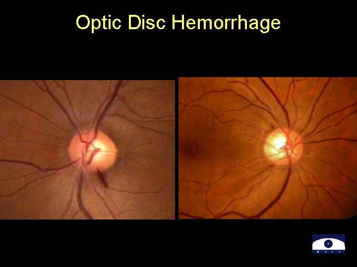 Optic Disc Hemorrhage 