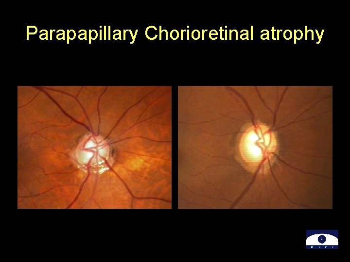 Parapapillary Chorioretinal atrophy 