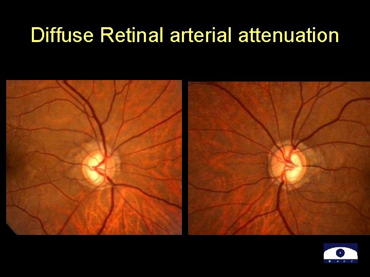 Diffuse Retinal arterial attenuation 
