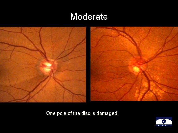 Moderate One pole of the disc is damaged 