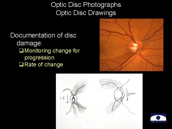 Optic Disc Photographs Optic Disc Drawings Documentation of disc damage: q. Monitoring change for