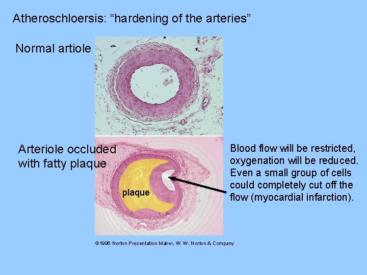 Atheroschloersis: “hardening of the arteries” Normal artiole Arteriole occluded with fatty plaque Blood flow