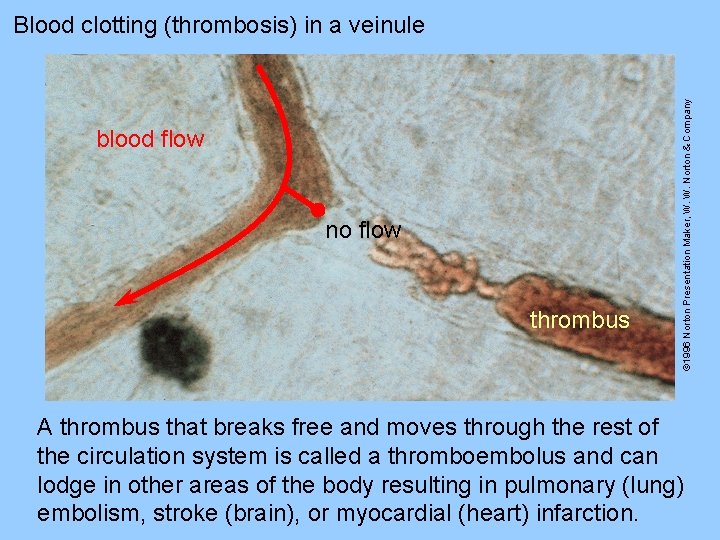 blood flow no flow thrombus © 1996 Norton Presentation Maker, W. W. Norton &