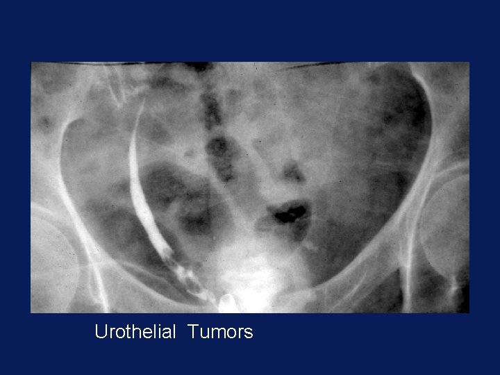 Urothelial Tumors 