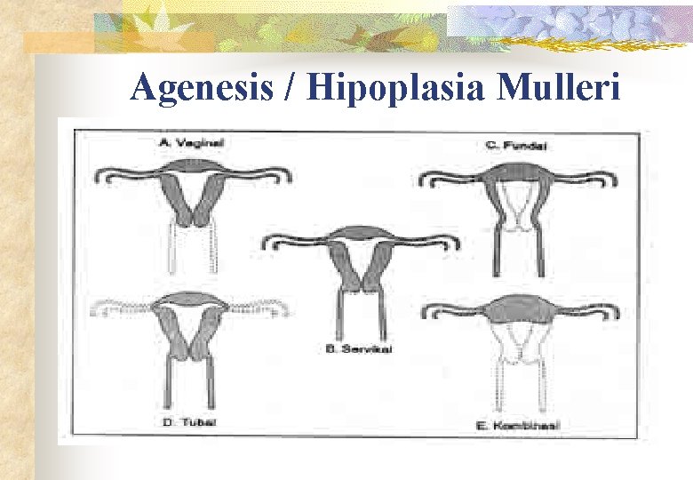 Agenesis / Hipoplasia Mulleri 