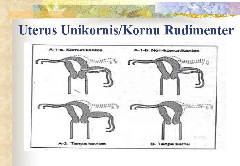 Uterus Unikornis/Kornu Rudimenter 