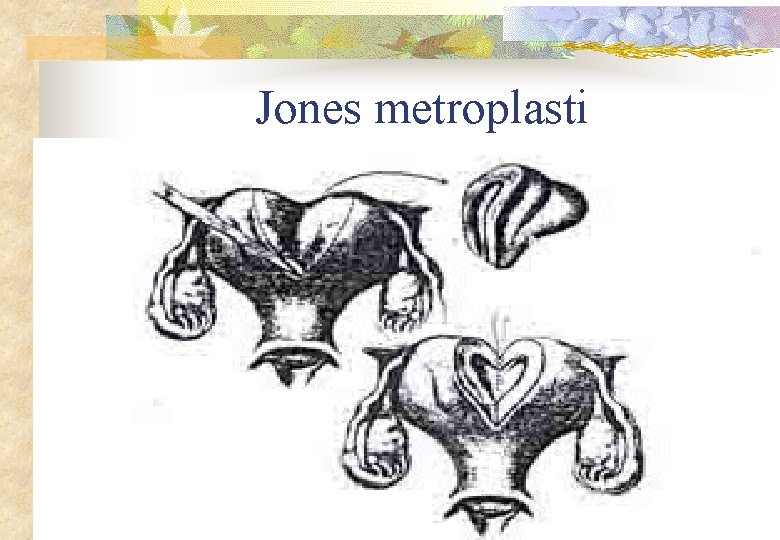 Jones metroplasti 