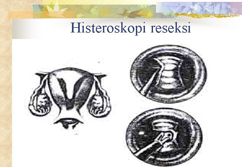 Histeroskopi reseksi 
