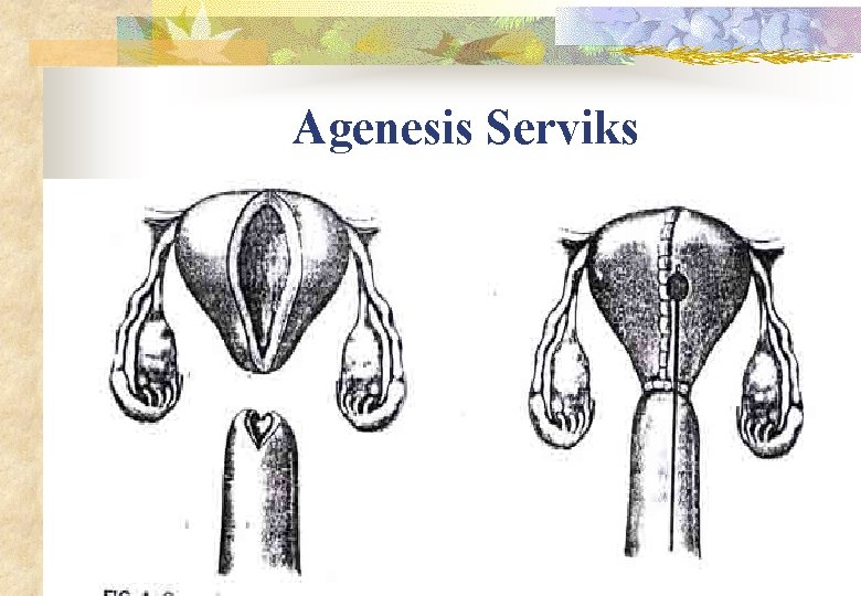 Agenesis Serviks 