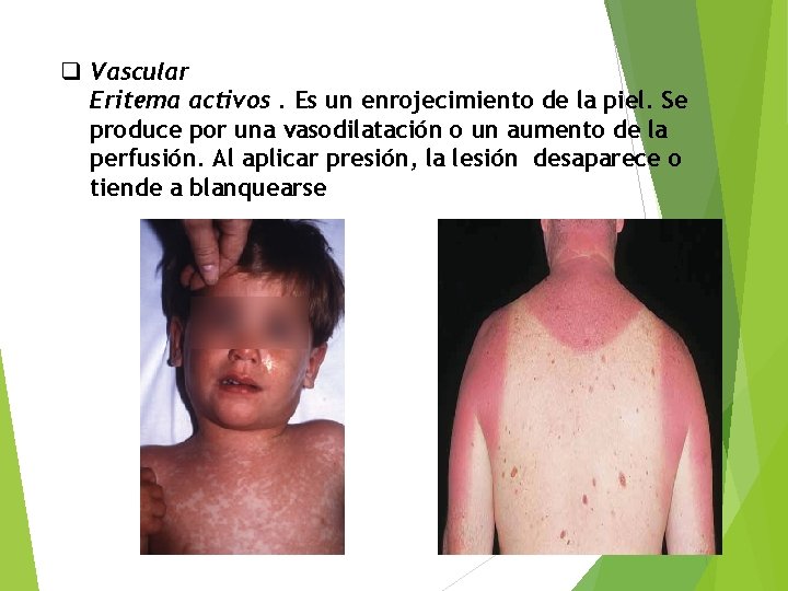 q Vascular Eritema activos. Es un enrojecimiento de la piel. Se produce por una