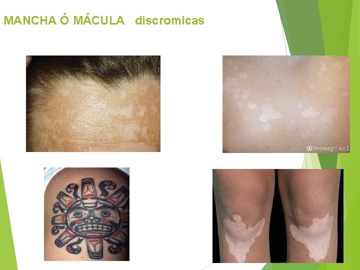 MANCHA Ó MÁCULA discromicas 