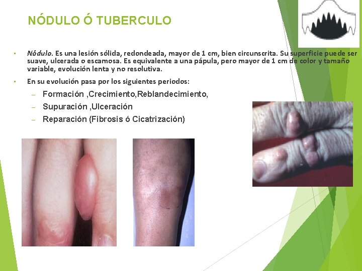 NÓDULO Ó TUBERCULO • Nódulo. Es una lesión sólida, redondeada, mayor de 1 cm,
