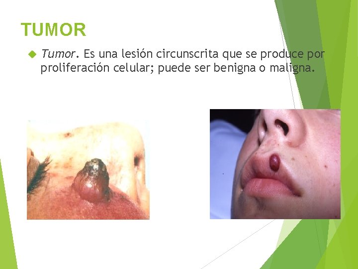TUMOR Tumor. Es una lesión circunscrita que se produce por proliferación celular; puede ser