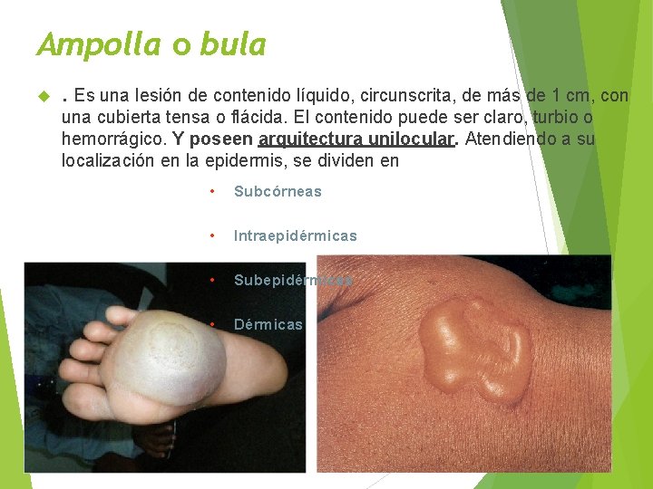 Ampolla o bula . Es una lesión de contenido líquido, circunscrita, de más de