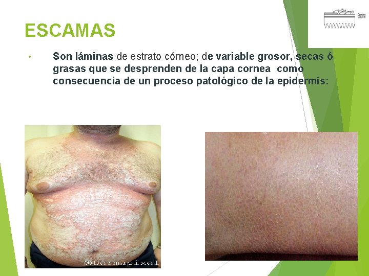 ESCAMAS • Son láminas de estrato córneo; de variable grosor, secas ó grasas que