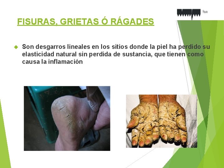FISURAS, GRIETAS Ó RÁGADES Son desgarros lineales en los sitios donde la piel ha