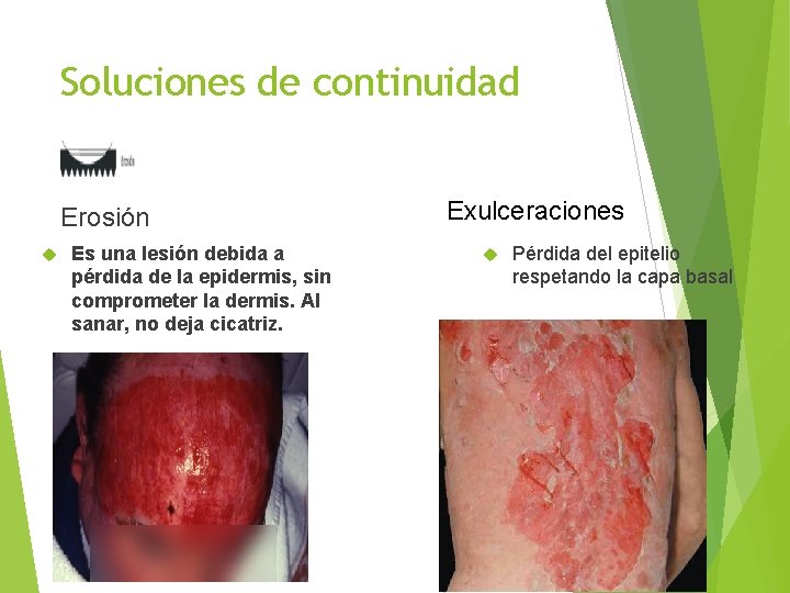 Soluciones de continuidad Erosión Es una lesión debida a pérdida de la epidermis, sin