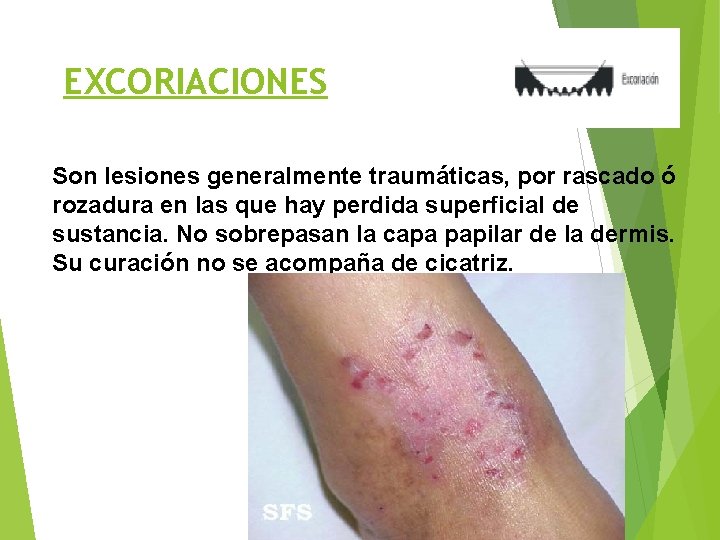 EXCORIACIONES Son lesiones generalmente traumáticas, por rascado ó rozadura en las que hay perdida