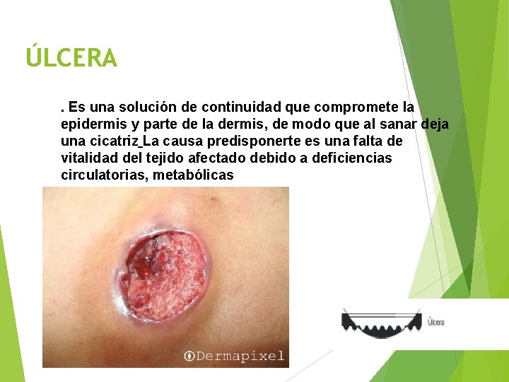ÚLCERA. Es una solución de continuidad que compromete la epidermis y parte de la