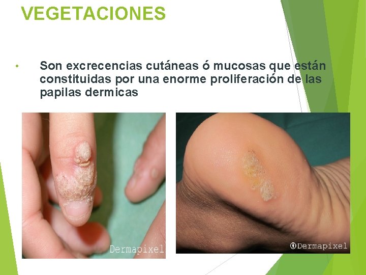 VEGETACIONES • Son excrecencias cutáneas ó mucosas que están constituidas por una enorme proliferación