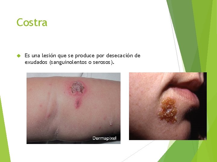 Costra Es una lesión que se produce por desecación de exudados (sanguinolentos o serosos).