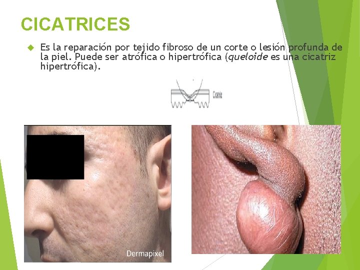 CICATRICES Es la reparación por tejido fibroso de un corte o lesión profunda de