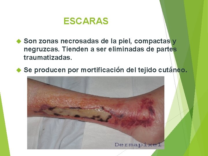 ESCARAS Son zonas necrosadas de la piel, compactas y negruzcas. Tienden a ser eliminadas