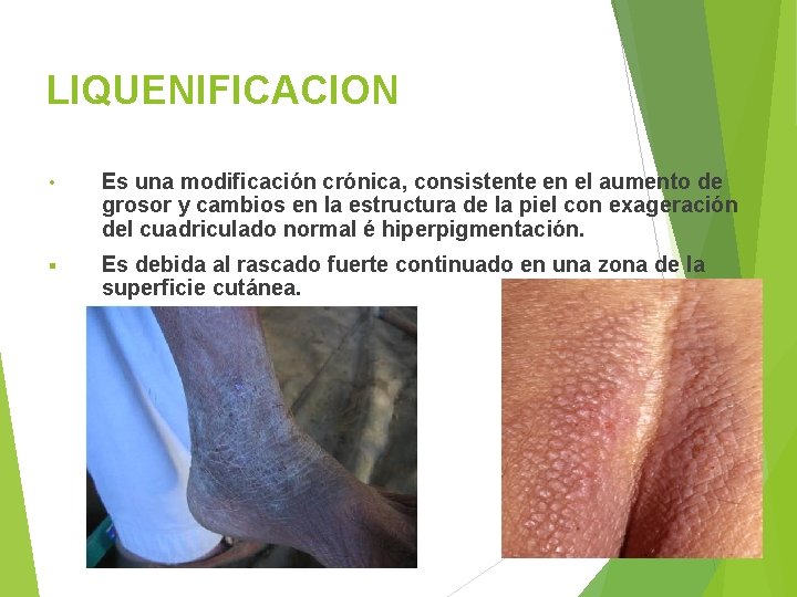 LIQUENIFICACION • Es una modificación crónica, consistente en el aumento de grosor y cambios
