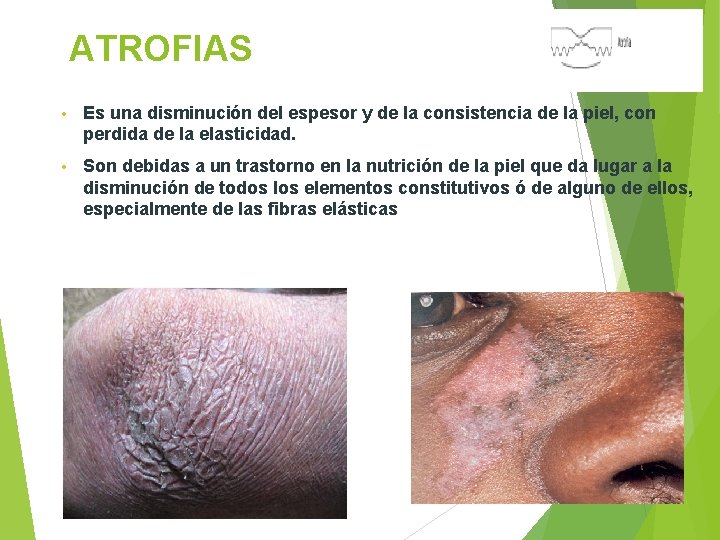 ATROFIAS • Es una disminución del espesor y de la consistencia de la piel,