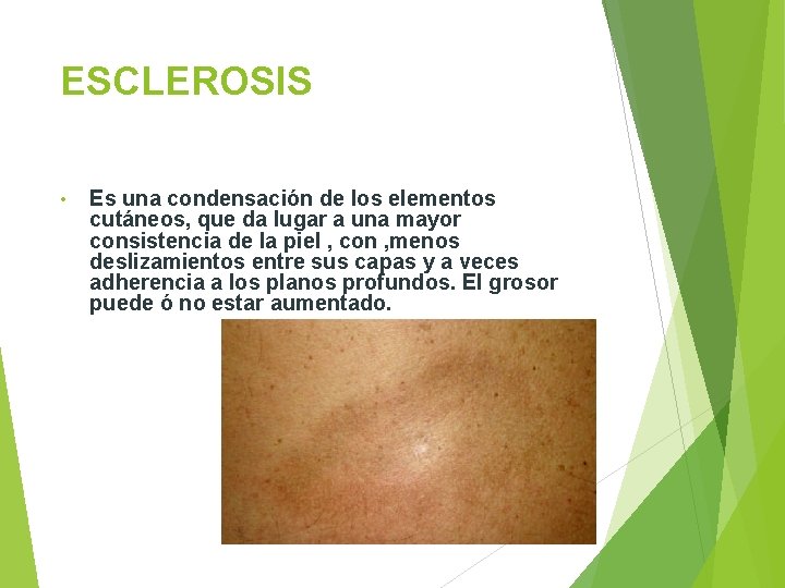 ESCLEROSIS • Es una condensación de los elementos cutáneos, que da lugar a una