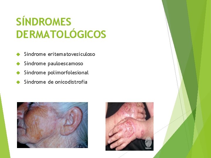 SÍNDROMES DERMATOLÓGICOS Sindrome eritematovesiculoso Sindrome pauloescamoso Sindrome polimorfolesional Sindrome de onicodistrofia 