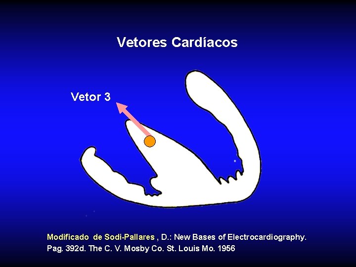 Vetores Cardíacos Vetor 3 Modificado de Sodi-Pallares , D. : New Bases of Electrocardiography.