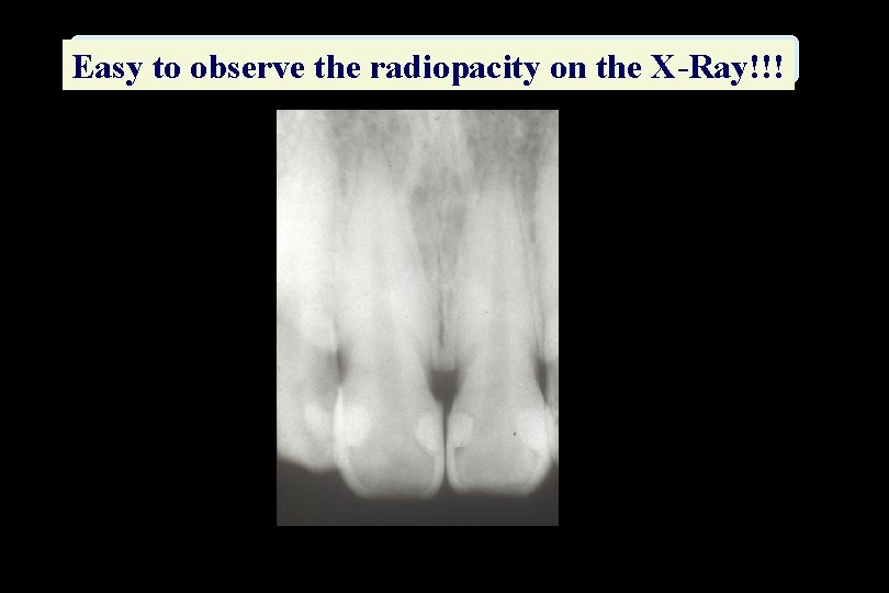 Easy to observe the radiopacity on the X-Ray!!! 