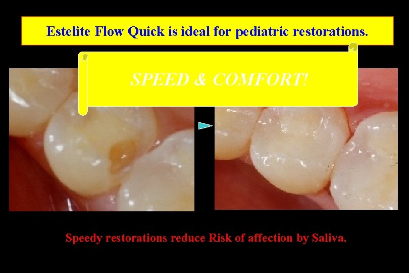 Estelite Flow Quick is ideal for pediatric restorations. SPEED & COMFORT! Speedy restorations reduce