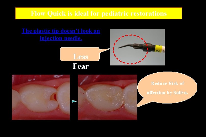 Flow Quick is ideal for pediatric restorations The plastic tip doesn’t look an injection