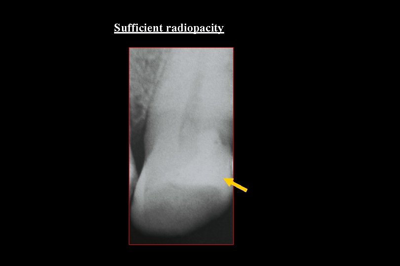 Sufficient radiopacity 