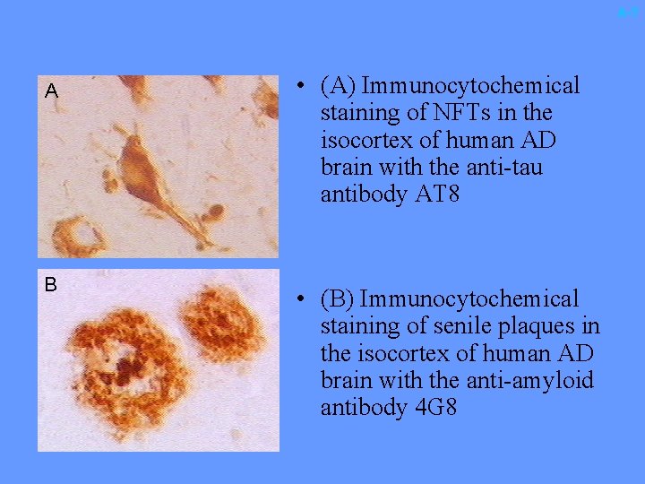 A-7 A B • (A) Immunocytochemical staining of NFTs in the isocortex of human