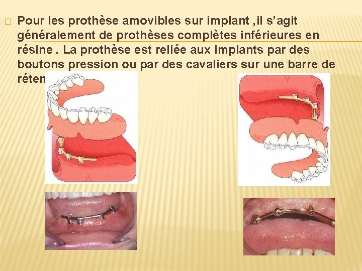 � Pour les prothèse amovibles sur implant , il s’agit généralement de prothèses complètes