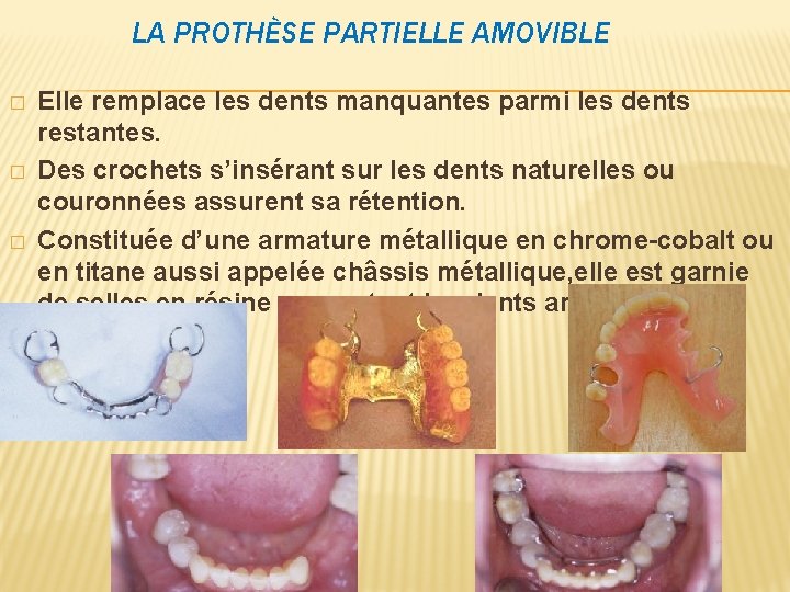 LA PROTHÈSE PARTIELLE AMOVIBLE � � � Elle remplace les dents manquantes parmi les