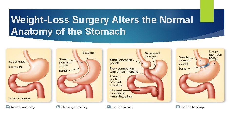 Weight-Loss Surgery Alters the Normal Anatomy of the Stomach 