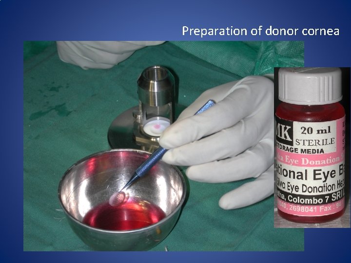 Preparation of donor cornea 