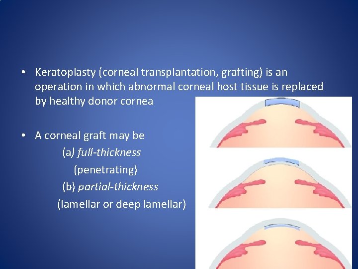  • Keratoplasty (corneal transplantation, grafting) is an operation in which abnormal corneal host