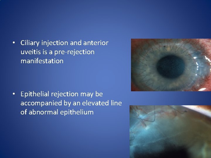  • Ciliary injection and anterior uveitis is a pre-rejection manifestation • Epithelial rejection