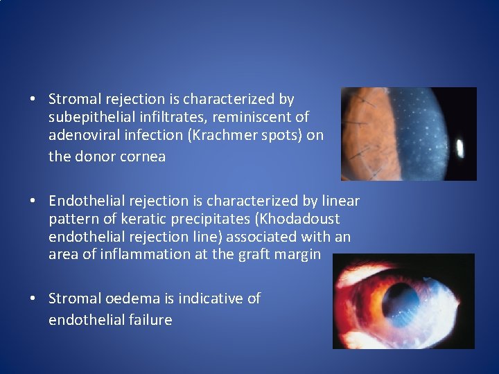  • Stromal rejection is characterized by subepithelial infiltrates, reminiscent of adenoviral infection (Krachmer